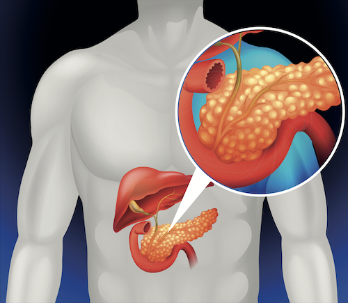 Pancreas cancer