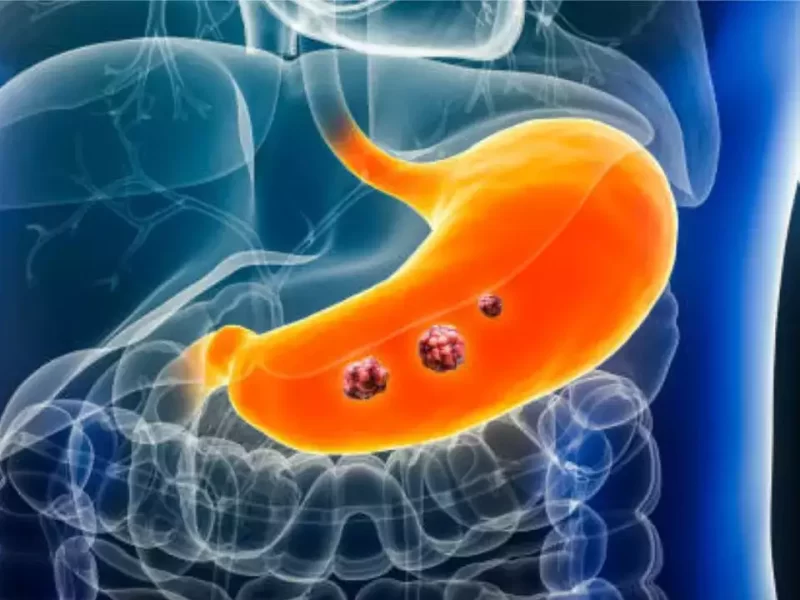 Abdominal-cancer