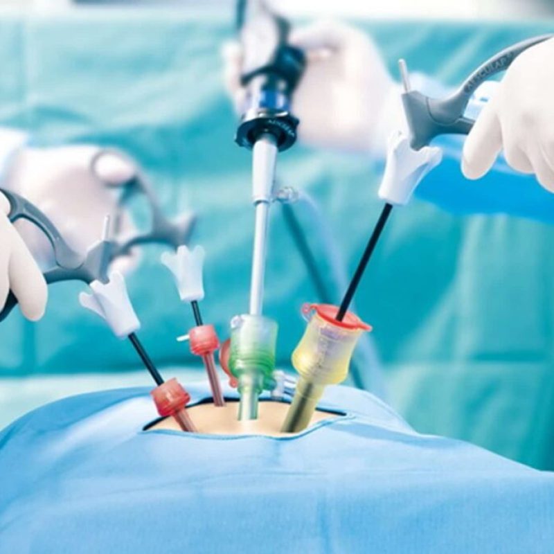 Laparoscopic-surgery