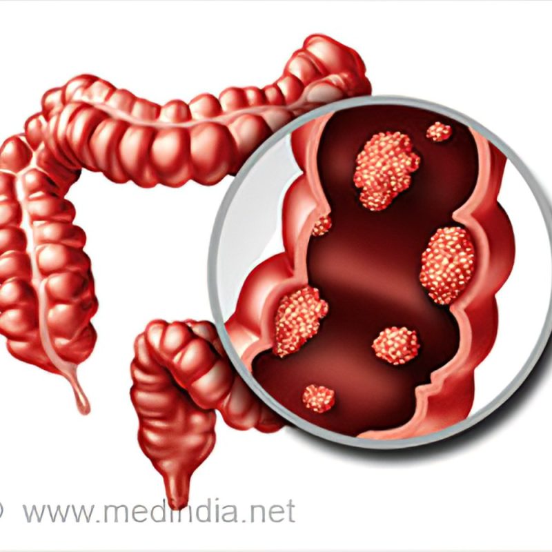 colorectal-cancer