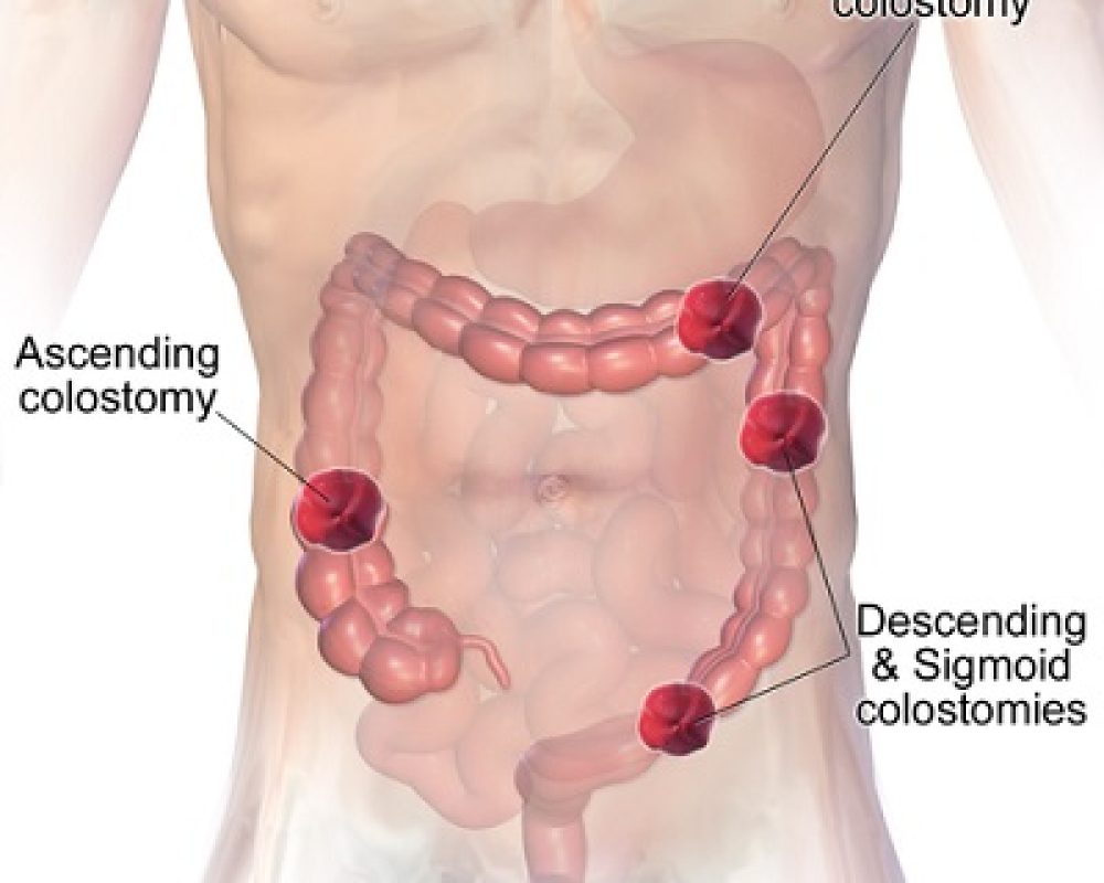 colostomy