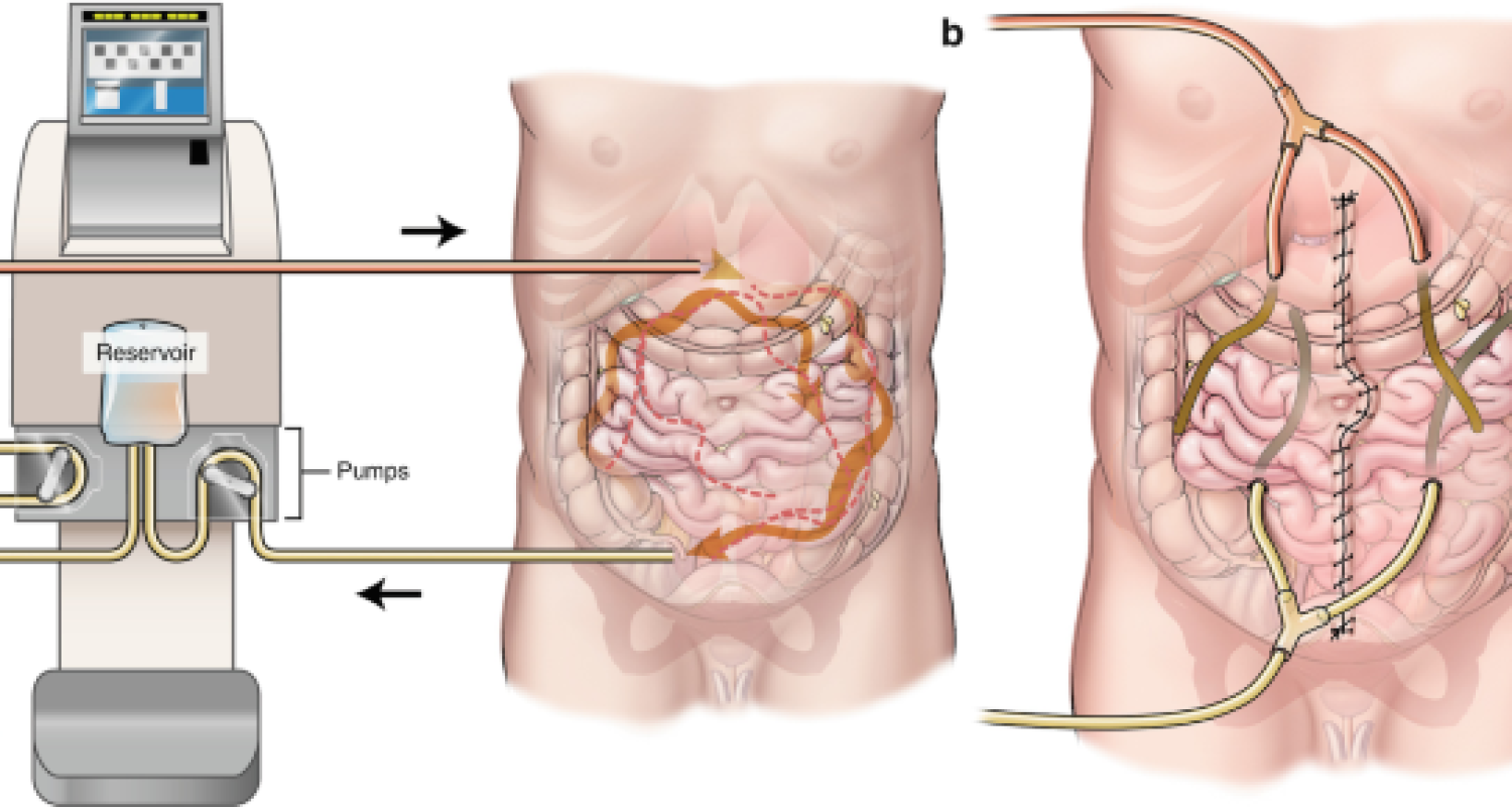 cytroreductive-chemotheropy