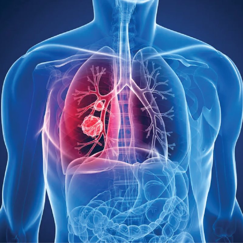 thoracic-cancer-01