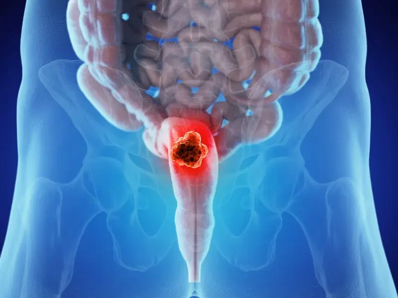 urinary-bladder-cancer
